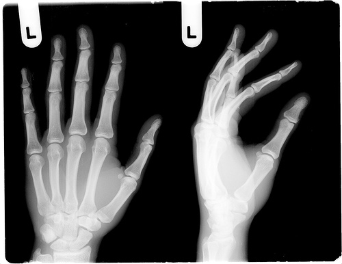 Biphosphonates under the legal X-ray.